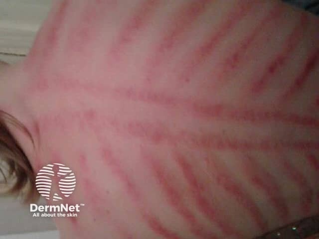 Коининг: следы традиционного скребкового растирания