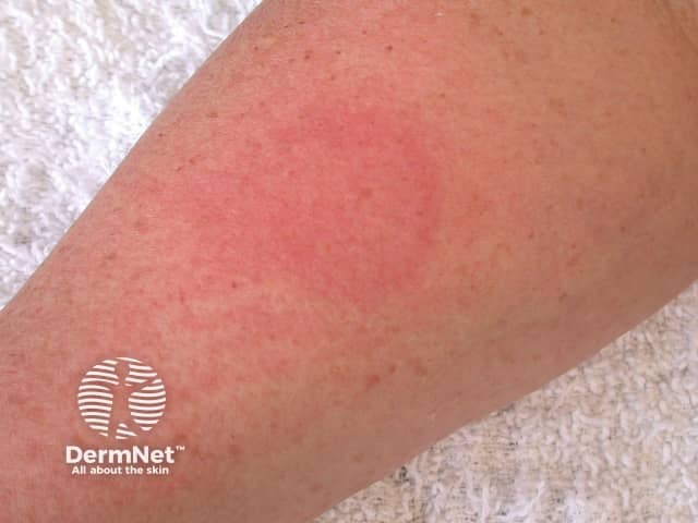 Увеличение волдыря через 5 минут после теста