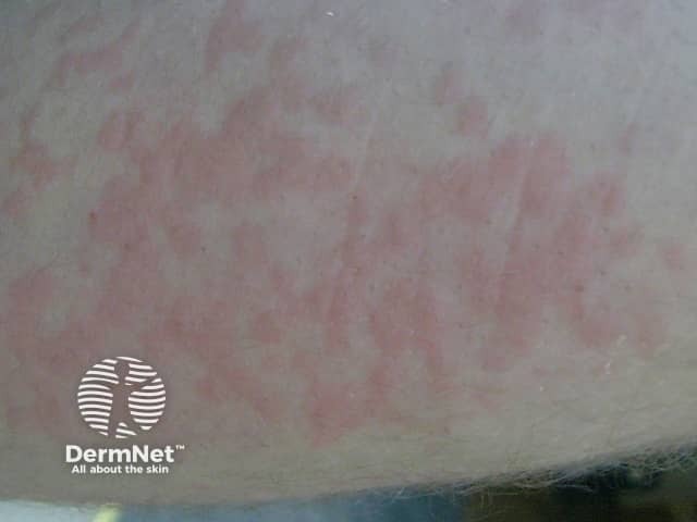 Холодовая крапивница