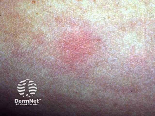 Положительная аллергическая проба на коллаген