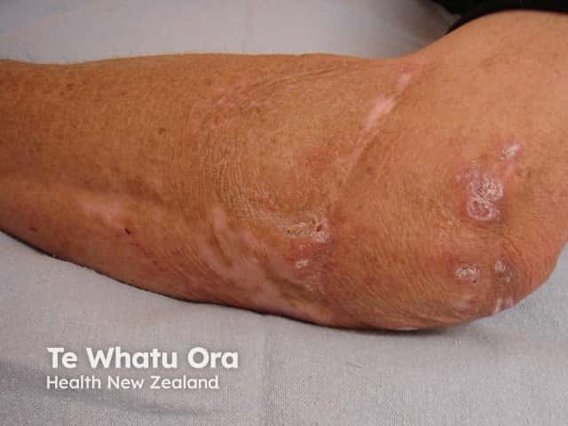 Гранулематозные узлы и папулы на коже у пациента с общей вариабельной иммунной недостаточностью