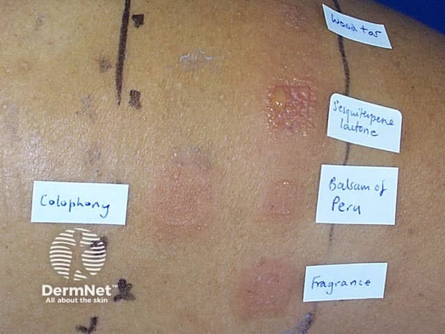 Аллергия на сложноцветные: положительные аппликационные кожные тесты на смесь сесквитерпеновых лактонов