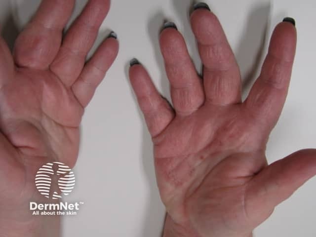 Дерматит от компьютерной мыши: характерное поражение возвышения тенара и гипотенара