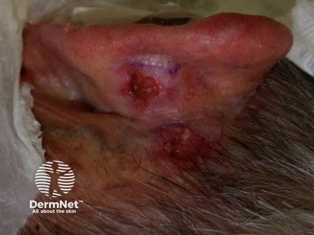 Изъязвленная форма базальноклеточной карциномы
