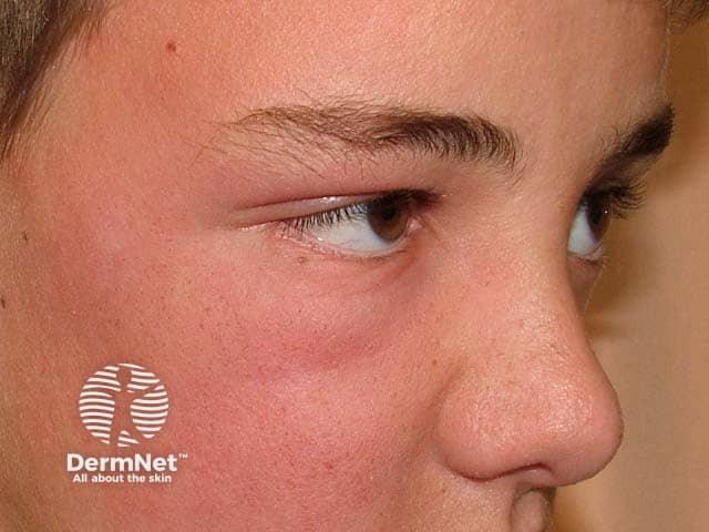 Дерматит кожи лица вследствие сенсибилизации к неомицину после закапывания ушных капель с антибиотиком собаке