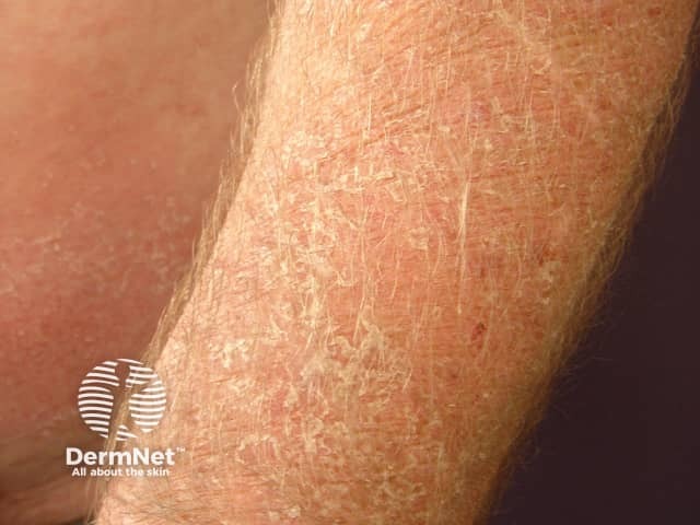 Аллергический контактный дерматит верхних и нижних конечностей