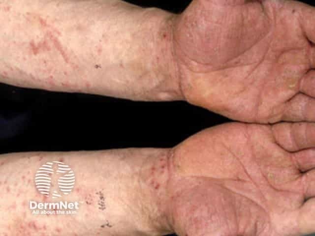 Аллергический контактный дерматит верхних и нижних конечностей