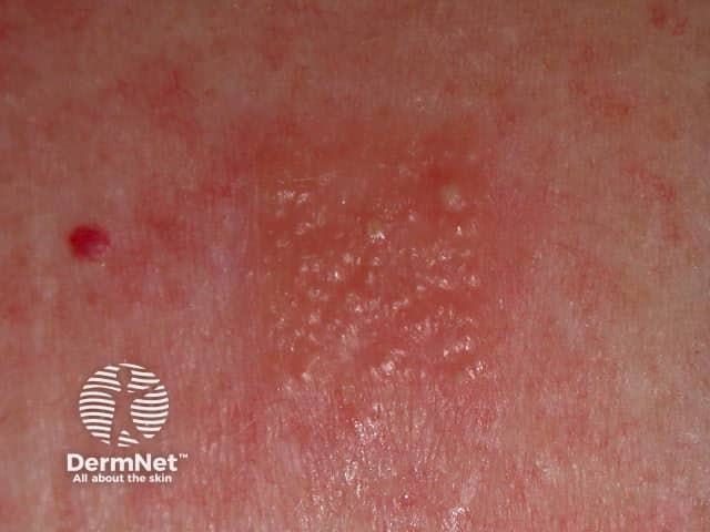 Положительная реакция аппликационной кожной пробы (патч-теста)