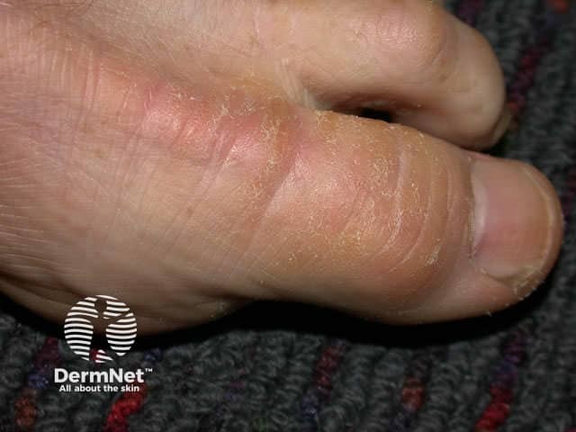 Омозолелость кисти у мотоциклиста