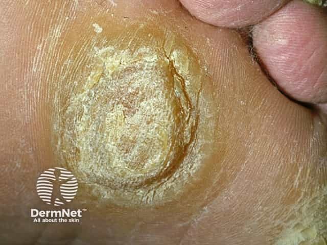 Стержневая мозоль стопы