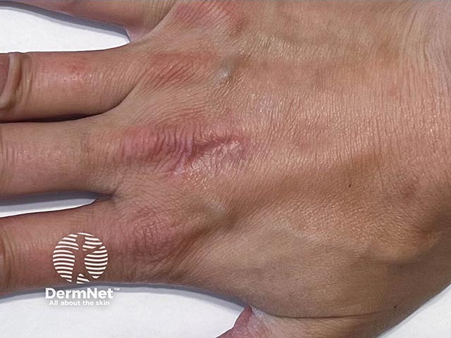 Едва заметный атрофический рубец после разрешения очага коровьей оспы