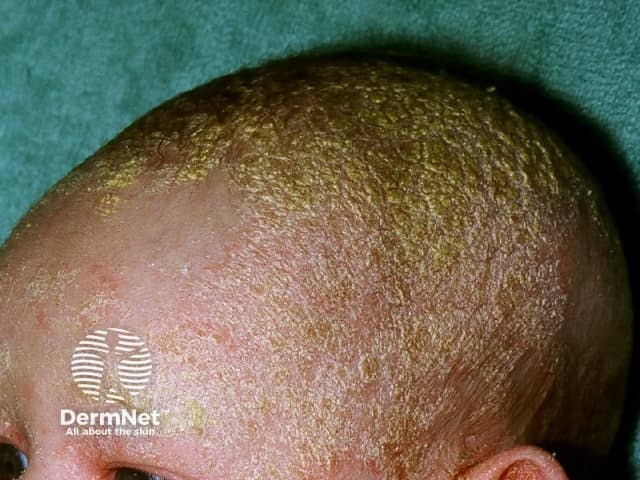 Гнейс волосистой части головы
