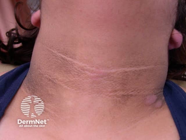 Чернеющий акантоз (Acanthosis nigricans)*
