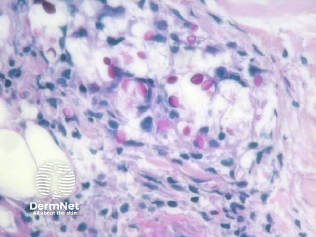 Рисунок 3. Дрожжевые клетки Cryptococcus, визуализированные при помощи ШИК-реакции (PAS-окраска).