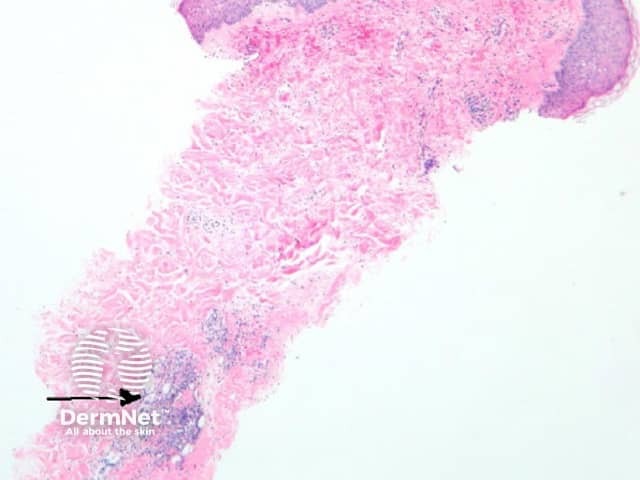 Рисунок 1. Дрожжевые формы Cryptococcus, окруженные выраженным слизистым отеком (указано стрелкой).