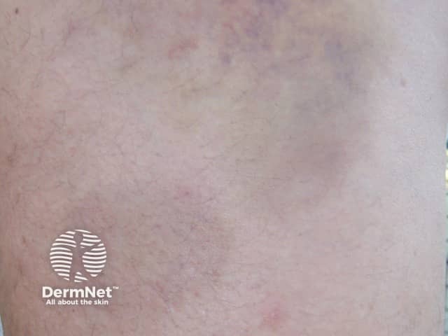 Дерматологические проявления после баночного массажа: петехии и экхимозы круглой формы