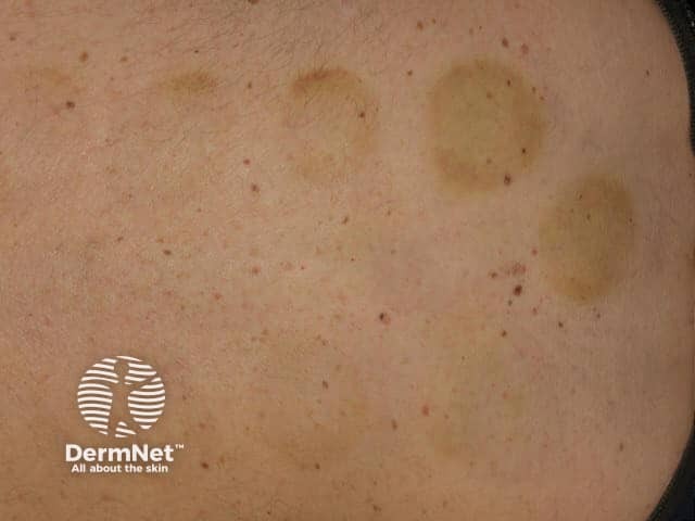 Четко очерченные геморрагические пятна и эритематозные кольца после вакуум-терапии