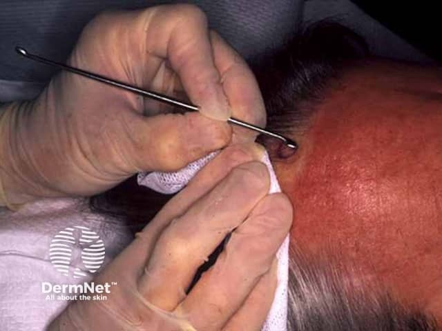 Кюретаж: удаление патологического очага дерматологической кюреткой