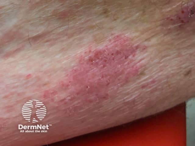 Дерматит, индуцированный пембролизумабом
