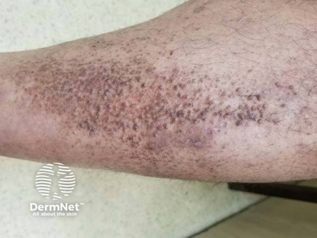 Шелушащиеся буровато-коричневые папулы, местами с линейным расположением, при лихеноидном амилоидозе голени