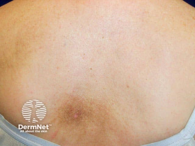 Стойкие расчесы в зоне парестетической ноталгии, приведшие к развитию пятнистого амилоидоза спины