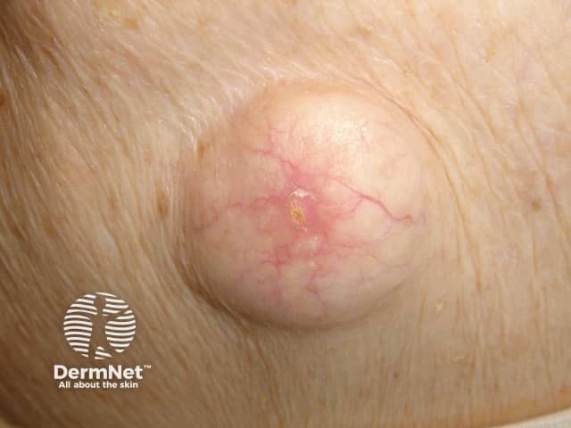 Киста
