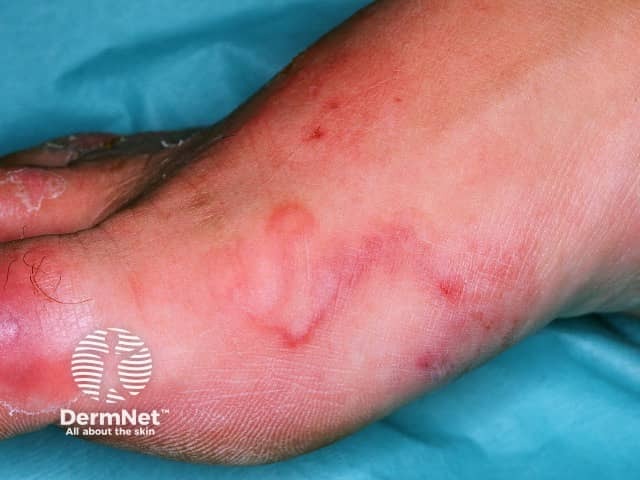 Кожная форма larva migrans: серпигинозные зудящие полосы на стопе