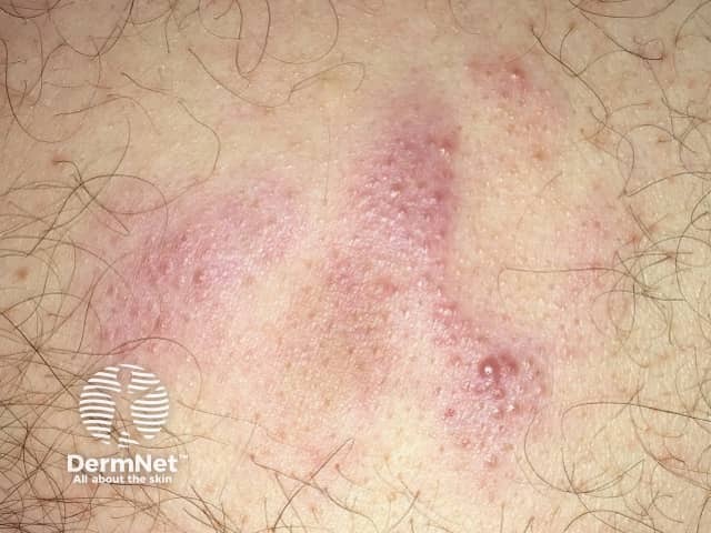 Кожная лимфома маргинальной зоны: узловое образование на туловище