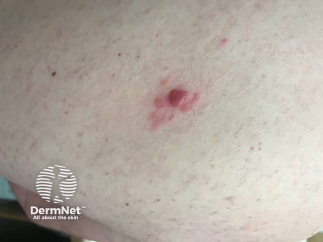 Клиническая картина лимфомы маргинальной зоны
