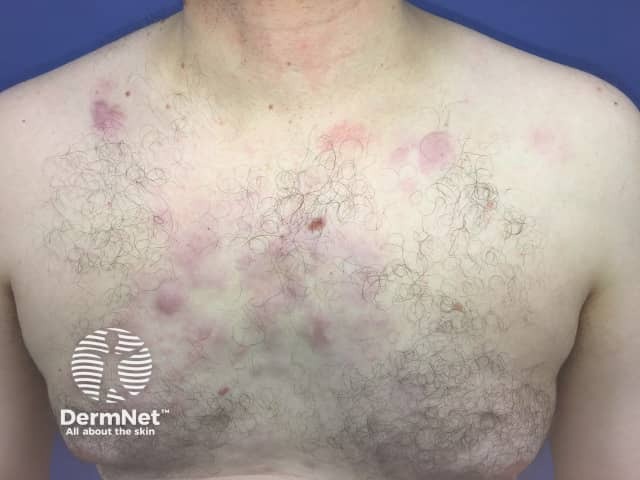 Кожная лимфома маргинальной зоны: эритематозный очаг поражения