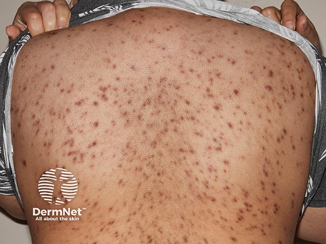 Распространенные узлы при плазмоцитозе в области спины.