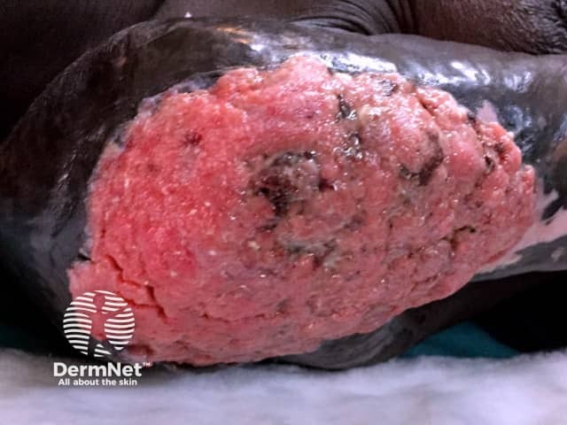 Распространенный плоскоклеточный рак кожи, развившийся на фоне рубца после термического ожога