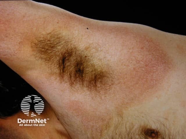 Сосудистая атрофическая пойкилодермия (Poikiloderma vasculare atrophicans)
