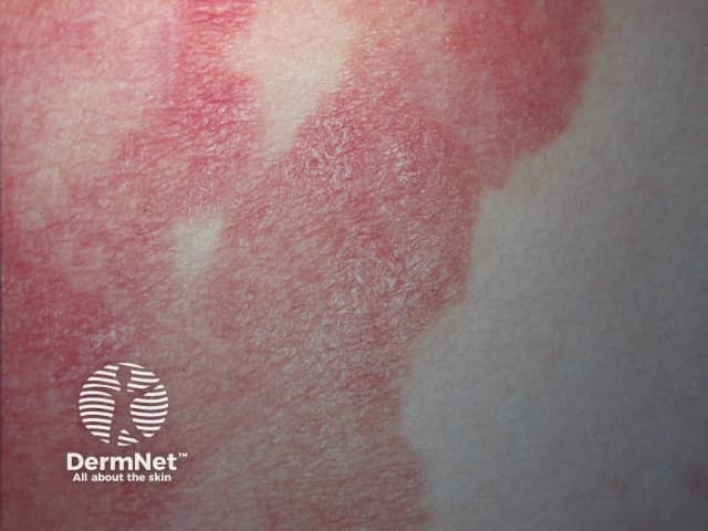 Грибовидный микоз (Mycosis fungoides)