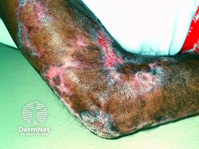 Туберкулезная волчанка (lupus vulgaris)