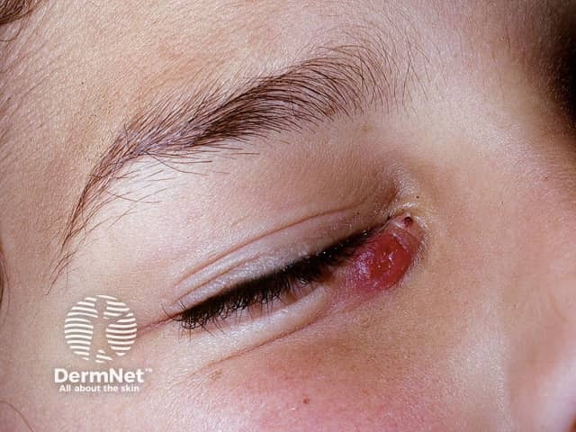 Туберкулезная волчанка (lupus vulgaris)