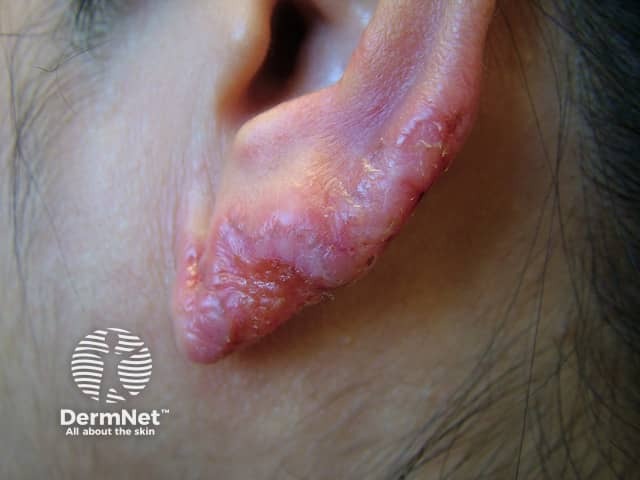Туберкулезная волчанка (lupus vulgaris)
