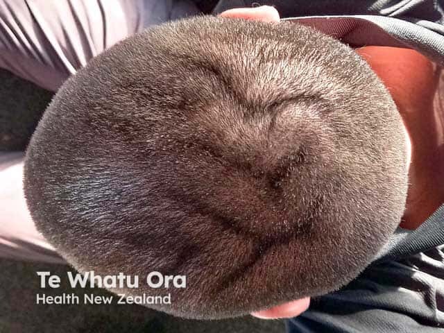 Складчатая кожа головы (Cutis verticis gyrata)