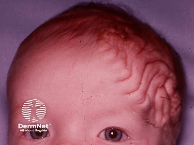 Складчатая кожа головы (Cutis verticis gyrata)