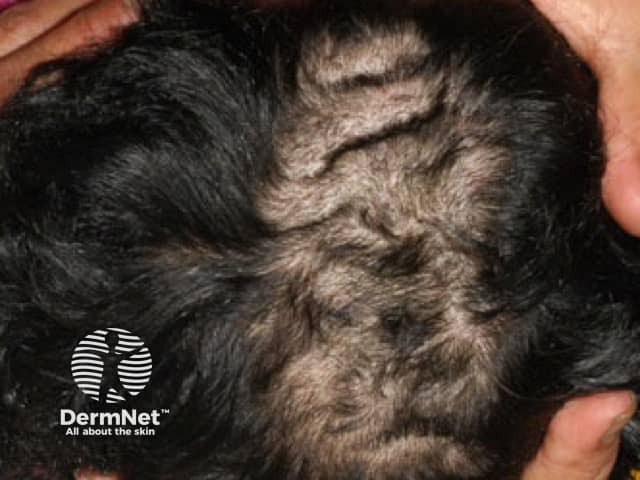 Складчатая кожа головы (Cutis verticis gyrata)