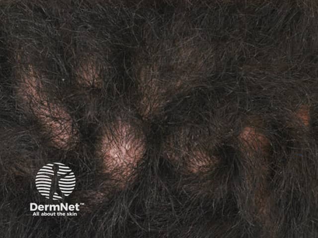 Складчатая кожа головы (Cutis verticis gyrata)