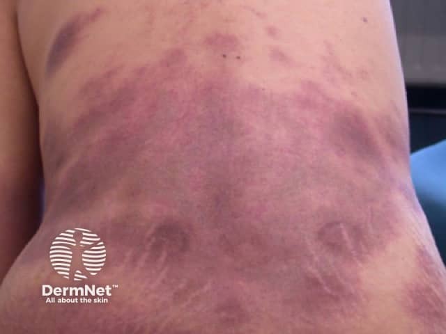 Цитофагический гистиоцитарный панникулит: клинические проявления в виде эритематозных узловатых элементов