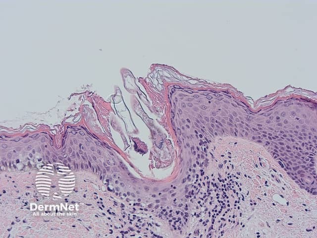 Клещ рода Demodex