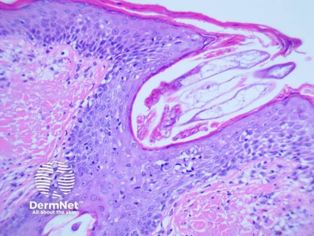 Гистологический препарат: клещ Demodex (увеличение x200)