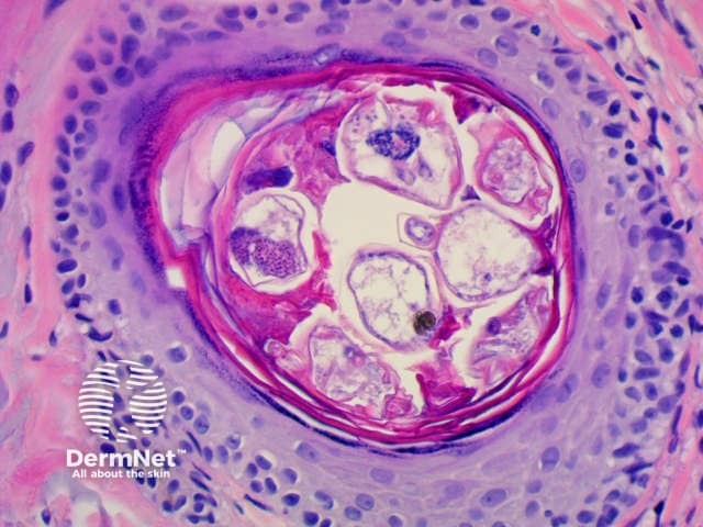 Гистологический препарат: клещ Demodex (увеличение x400)