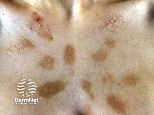 Артифициальный дерматит