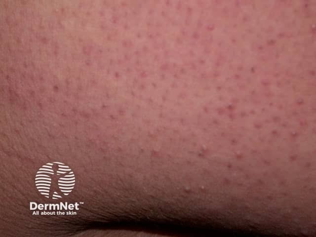 Волосяной кератоз (keratosis pilaris)