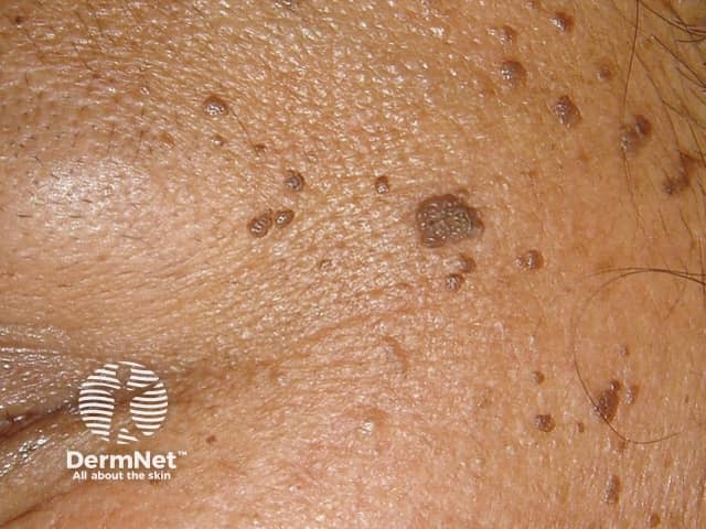 Черный папулезный дерматоз: поражение кожи лица у пациента с темным фототипом кожи