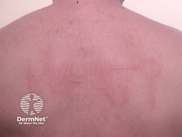 Дермографизм: линейные уртикарные элементы (волдыри) с перифокальной эритемой после механического раздражения