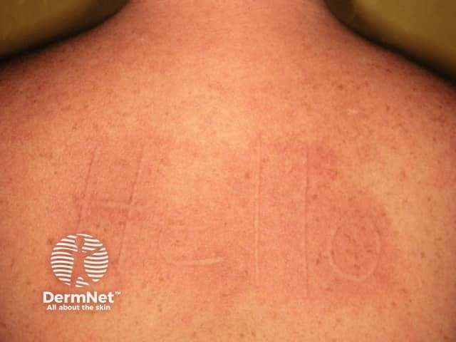 Дермографизм: появление локального отека и гиперемии вдоль линии давления